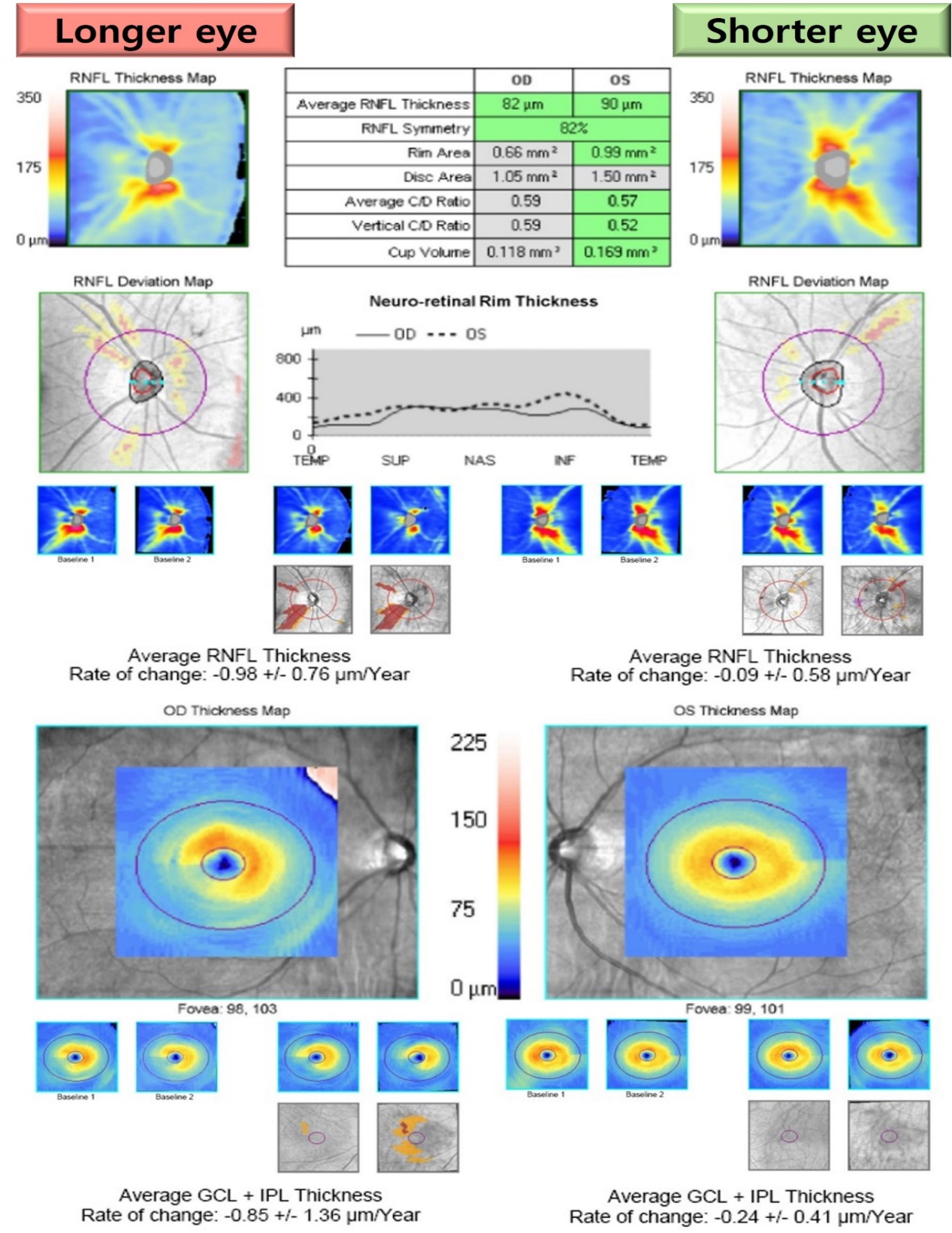비대칭 안축장을 가진 환자의 양안 녹내장 진행 비교. 안축장 차이가 1mm 이상인 긴 눈에서 짧은 눈보다 망막신경섬유층 및 신경절세포층 두께가 더 빠른 속도로 얇아짐(녹내장이 더 빨리 진행함)을 보여줌