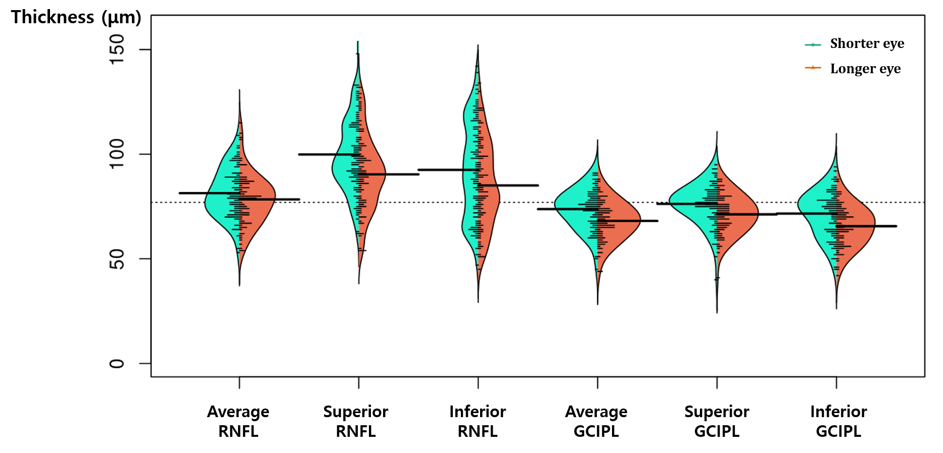 안축장이 긴 눈과 짧은 눈의 망막신경섬유층 및 신경절세포층 두께의 비교. 단면 분석에서 안축장이 긴 눈이 짧은 눈보다 망막신경섬유층과 신경절세포층 두께가 더 얇음(녹내장의 상태가 더 심각함)을 확인할 수 있음